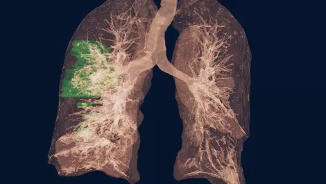 NVIDIA expands Clara healthcare platform to help fight COVID-19